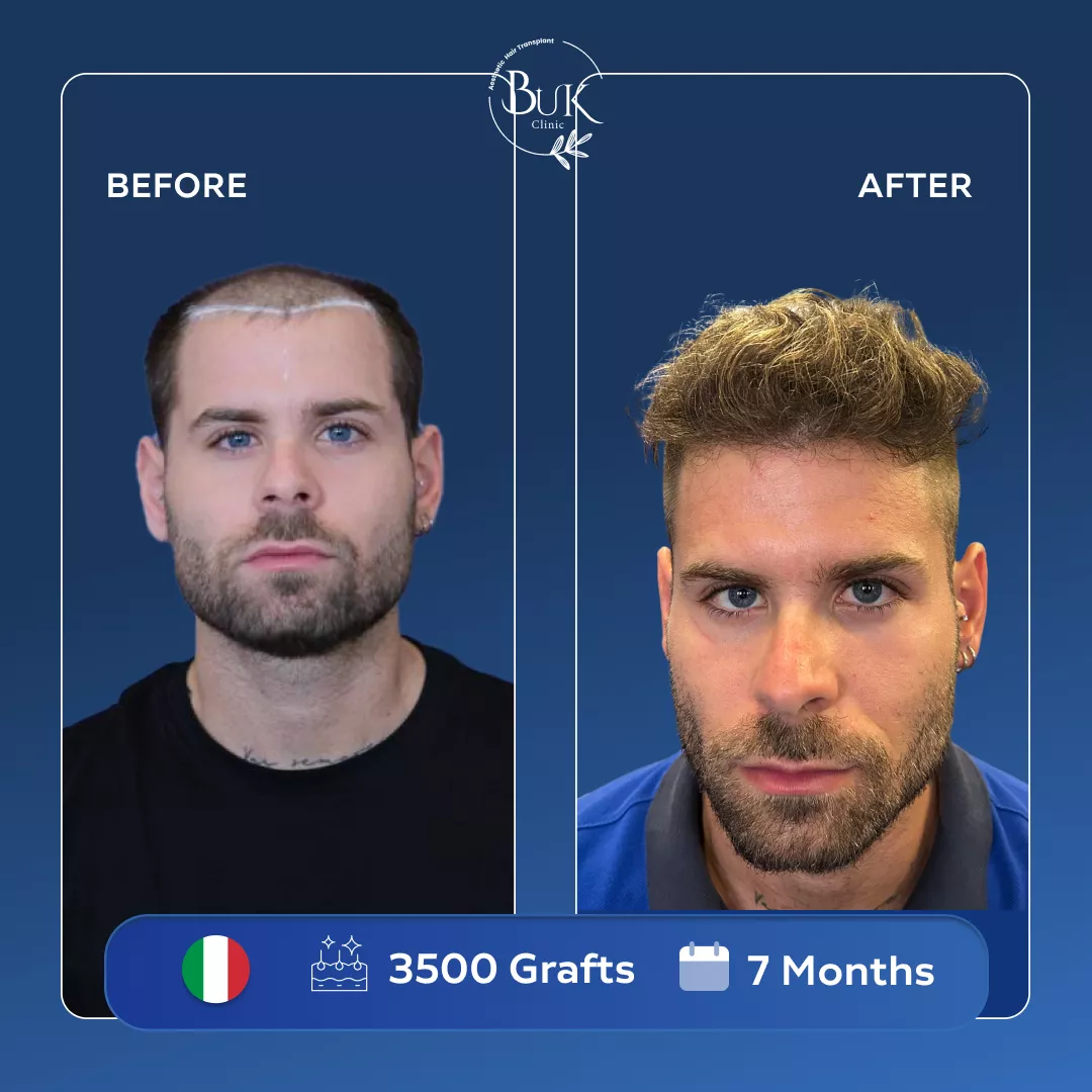 Hair Transplant Turkey Price, Istanbul 2026 | Buk Clinic